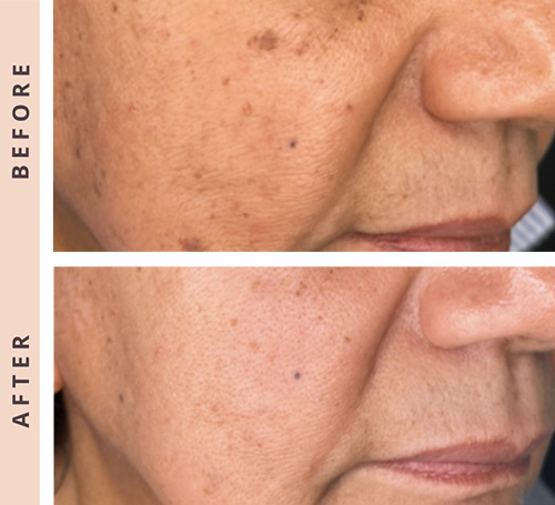 Laser CoolPeel B:A.jpg Laser CoolPeel B:A.jpg