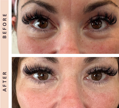 Laser Everesse B:A.jpg Laser Everesse B:A.jpg