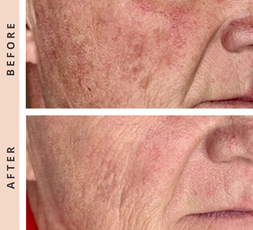 Laser Tetra B:A Laser Tetra B:A