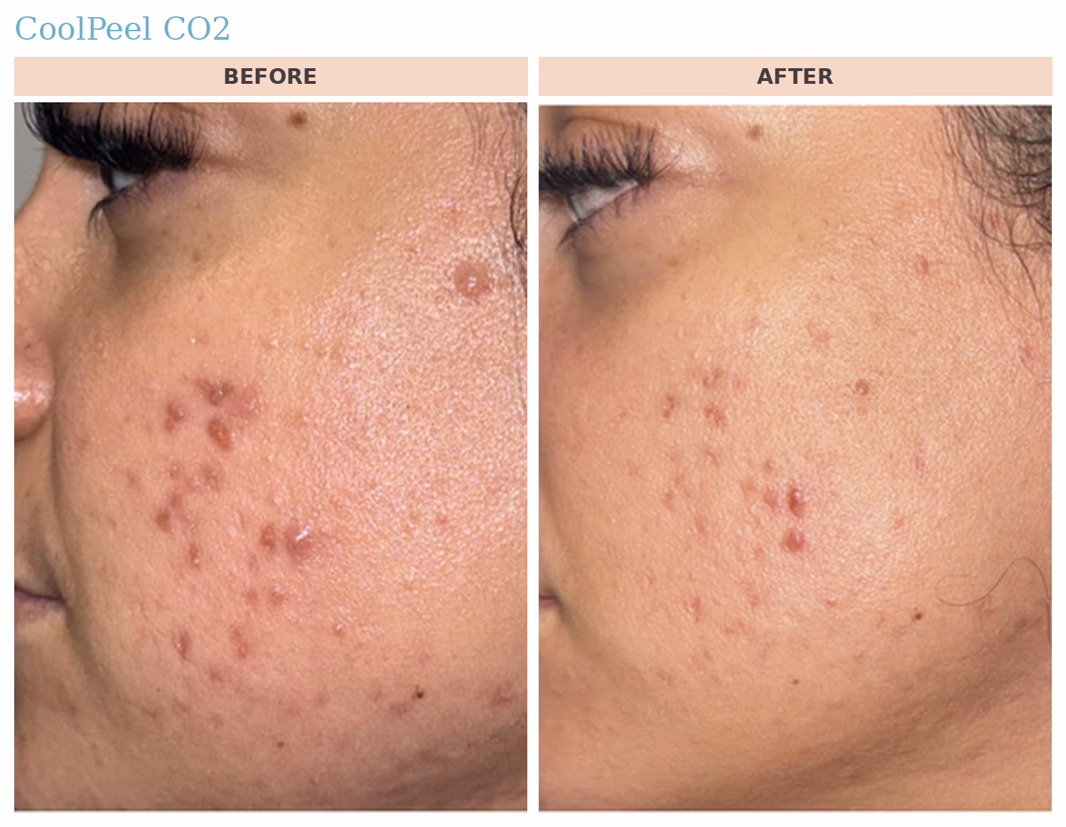 CoolPeel CO2 Acne Before and After CoolPeel CO2 before and after: reduced acne blemishes and smoother cheek texture