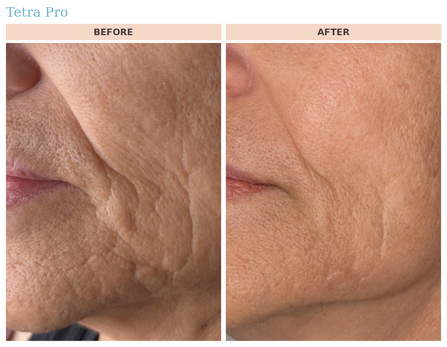 Tetra Pro Skin Texture Before and After Tetra Pro CO2 before and after: improved skin texture and softened fine lines