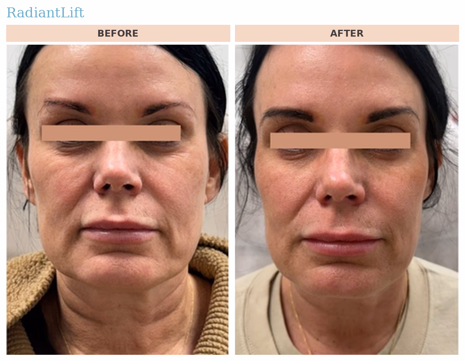 RadiantLift Front View Before and After RadiantLift CO2 before and after, front view: smoother skin and improved facial contour