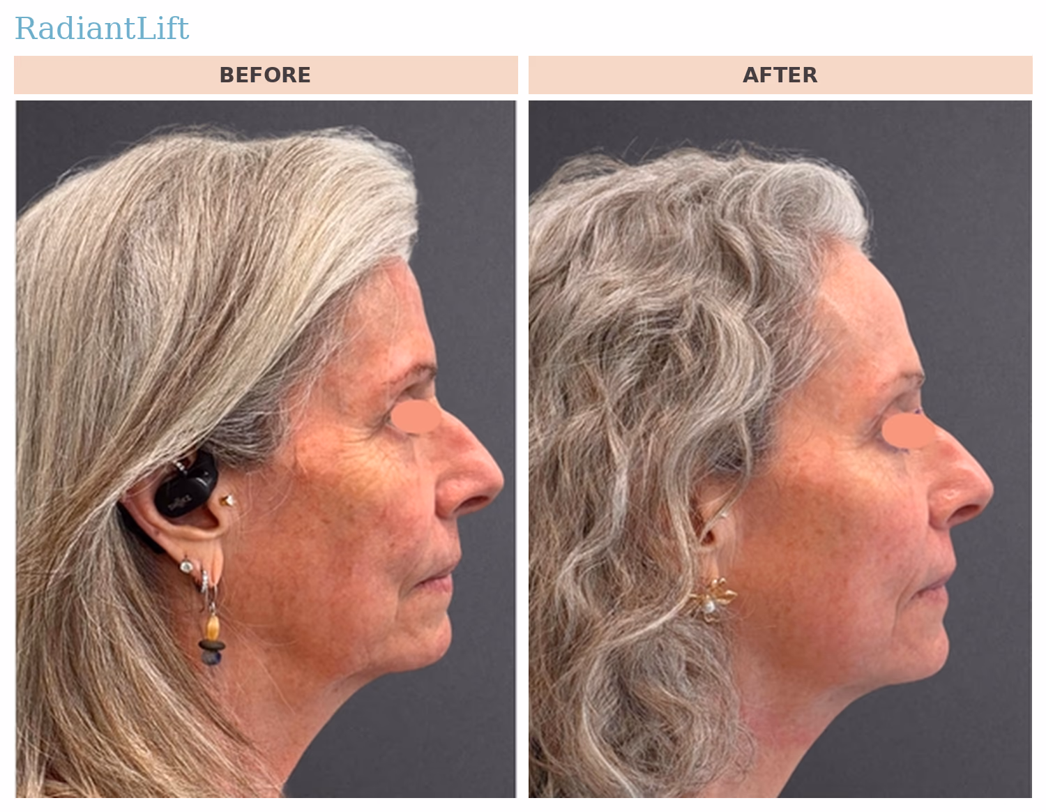 RadiantLift Profile Before and After RadiantLift CO2 before and after, profile view: tighter jawline and neck definition