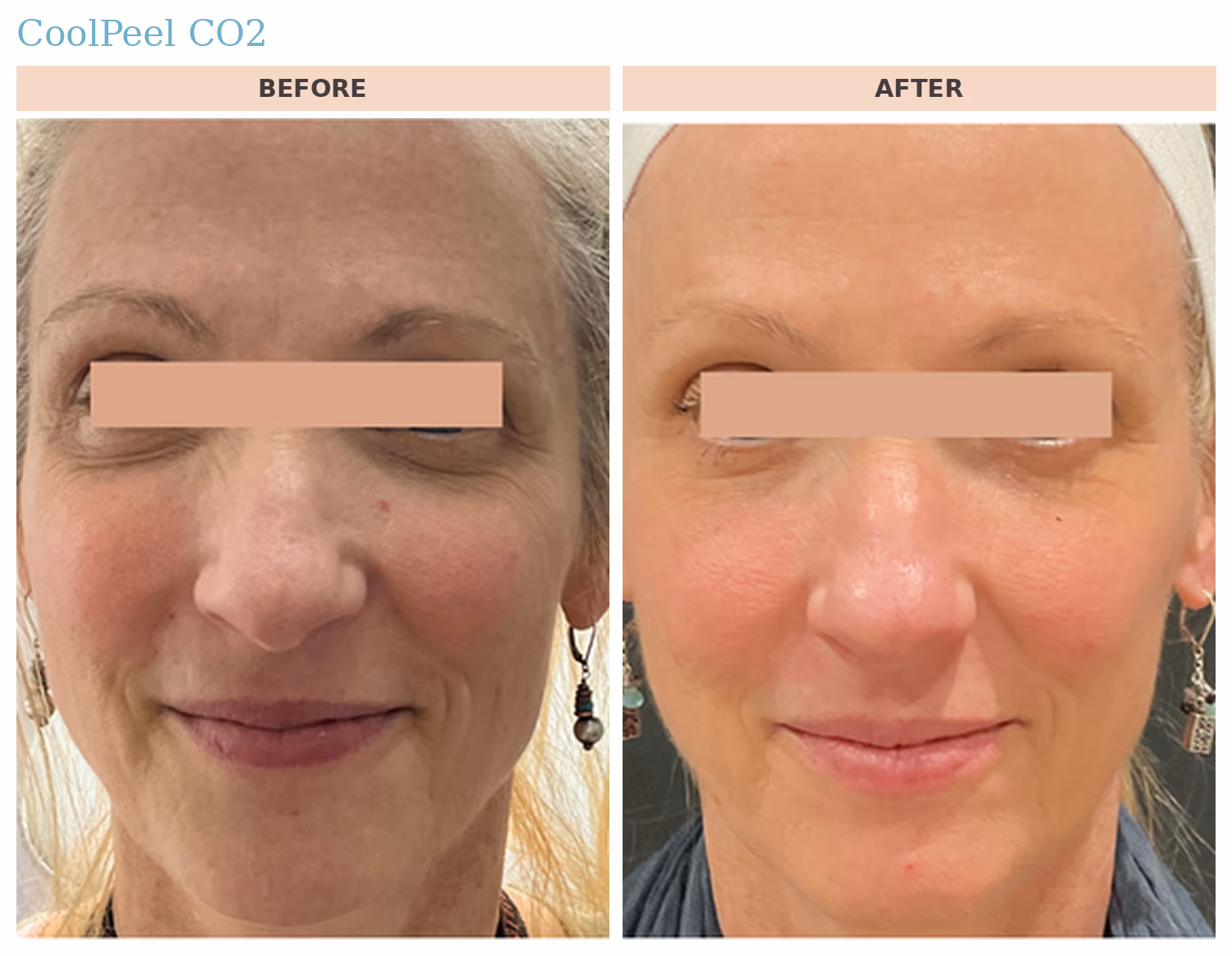 CoolPeel CO2 Face Before and After CoolPeel CO2 before and after: refined skin texture and reduced sun damage