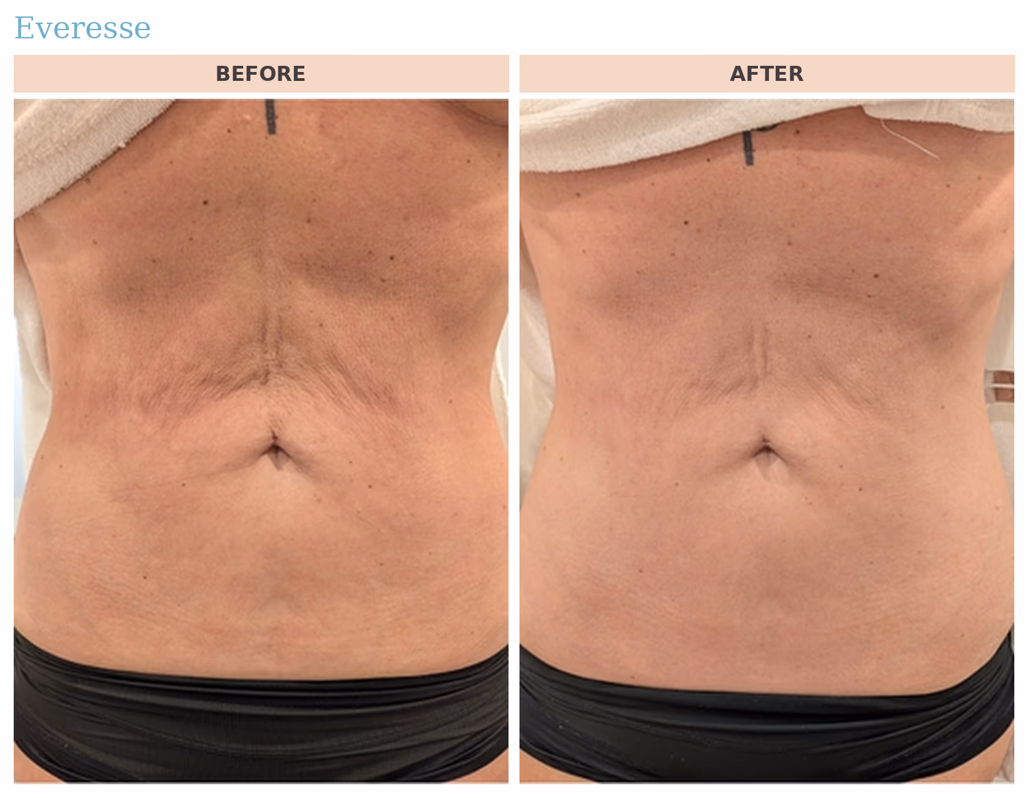 Everesse Abdomen Before and After Everesse before and after: abdominal skin tightening