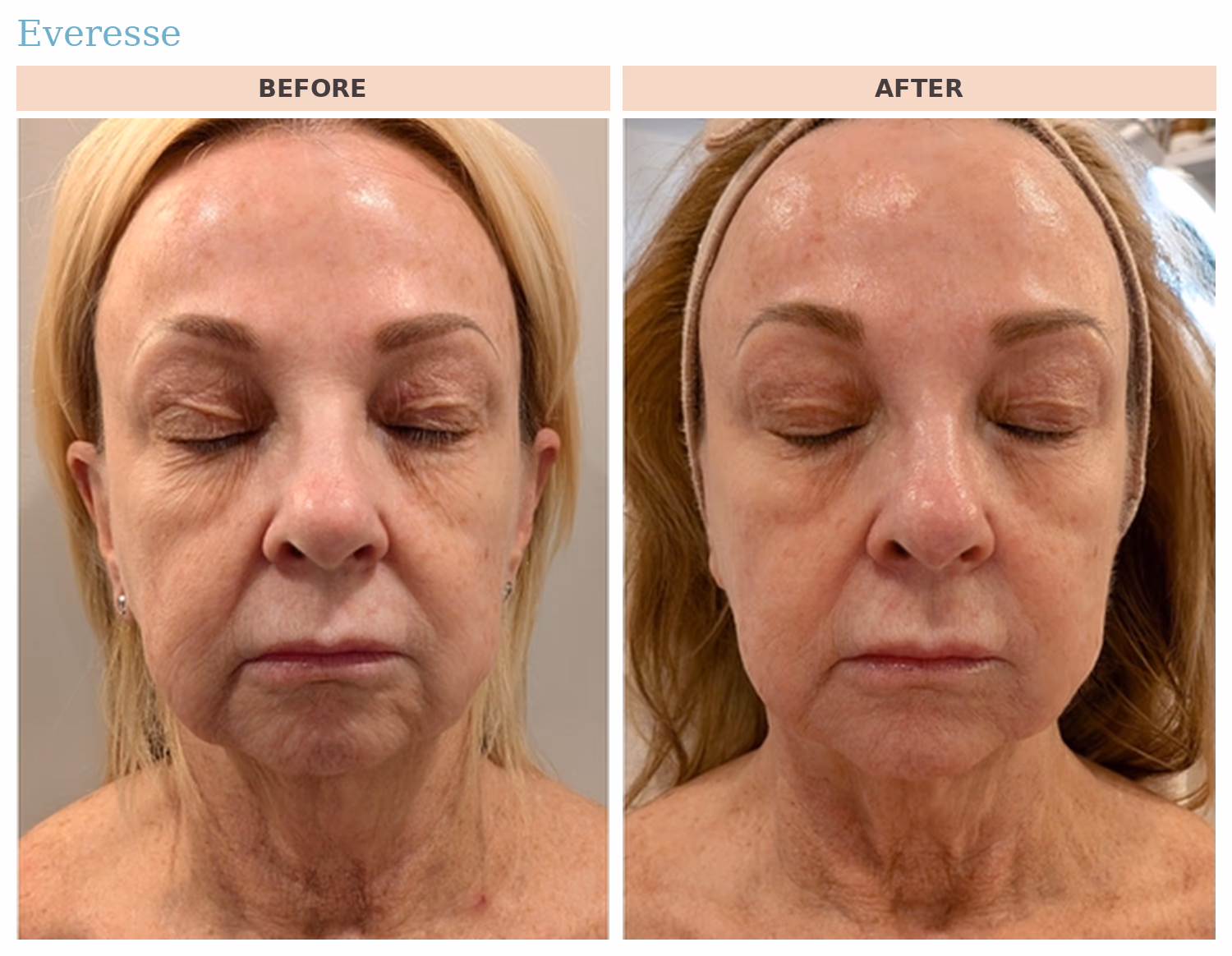 Everesse Face Before and After Everesse before and after: facial skin tightening and jawline definition