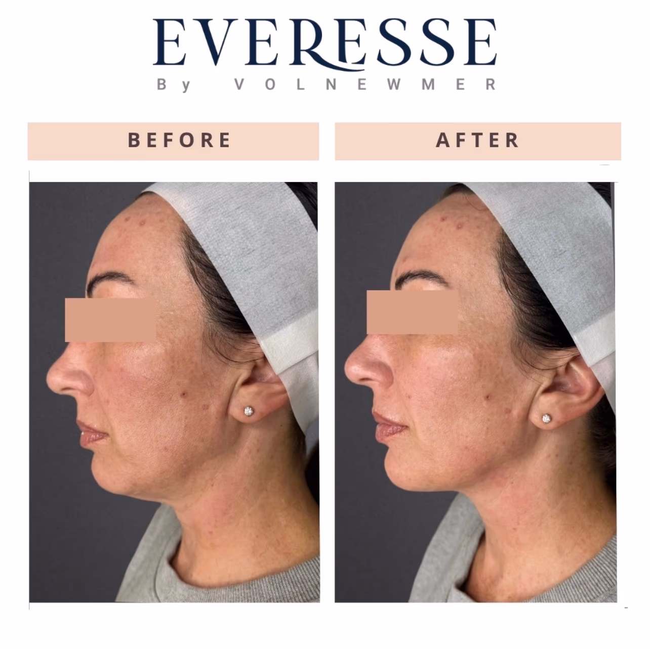 Everesse Jawline and Neck Before and After Everesse before and after: jawline and neck skin tightening, side profile
