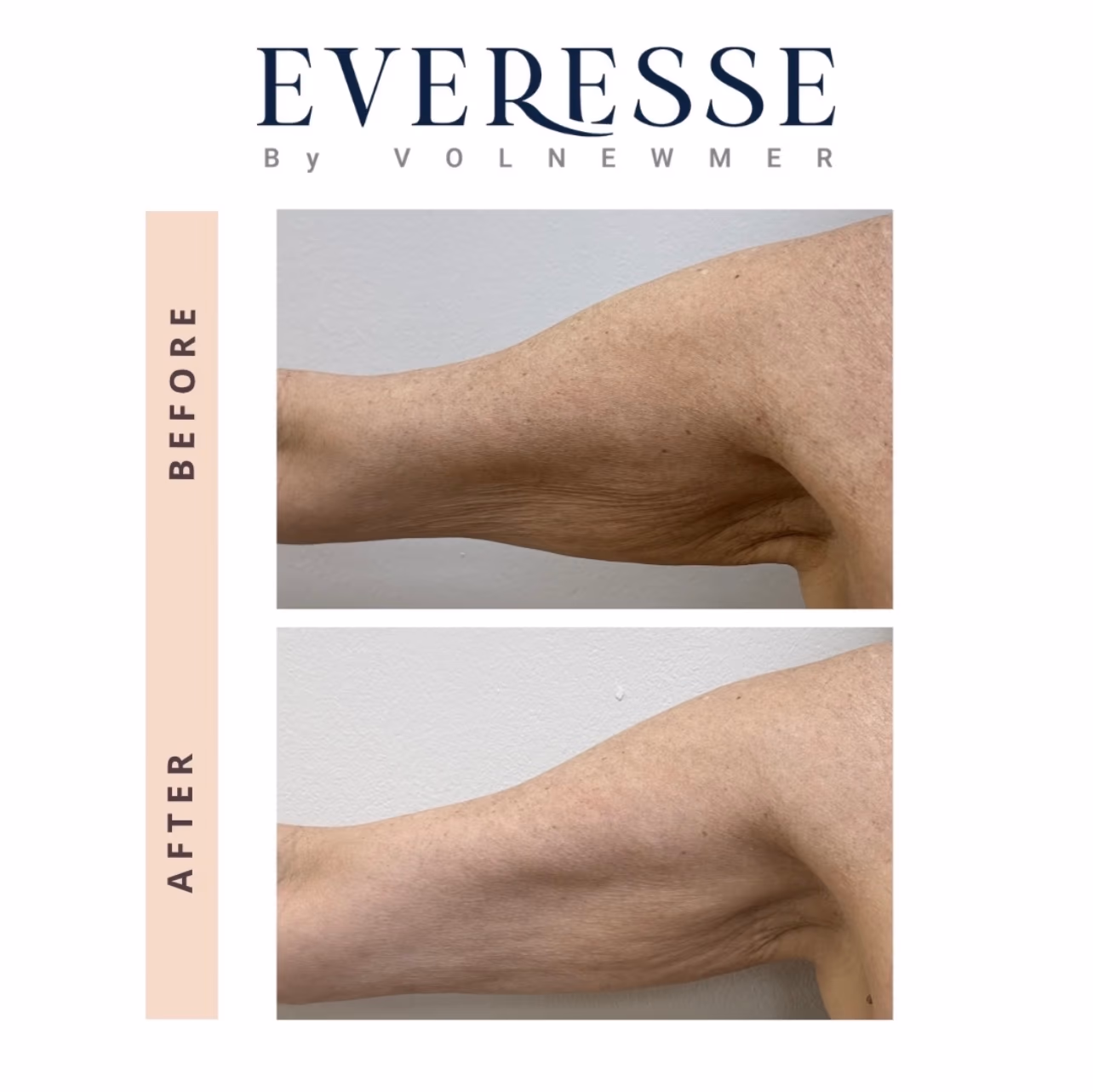 Everesse Upper Arm Before and After Everesse before and after: upper arm skin tightening