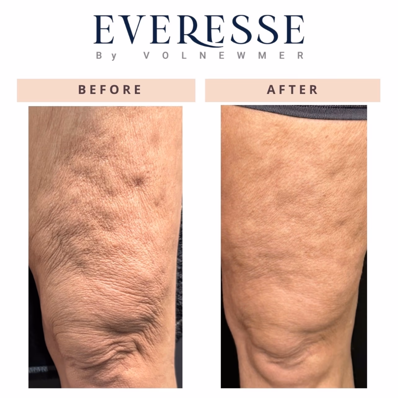 Everesse Knee and Thigh Before and After Everesse before and after: skin tightening above the knee and lower thigh