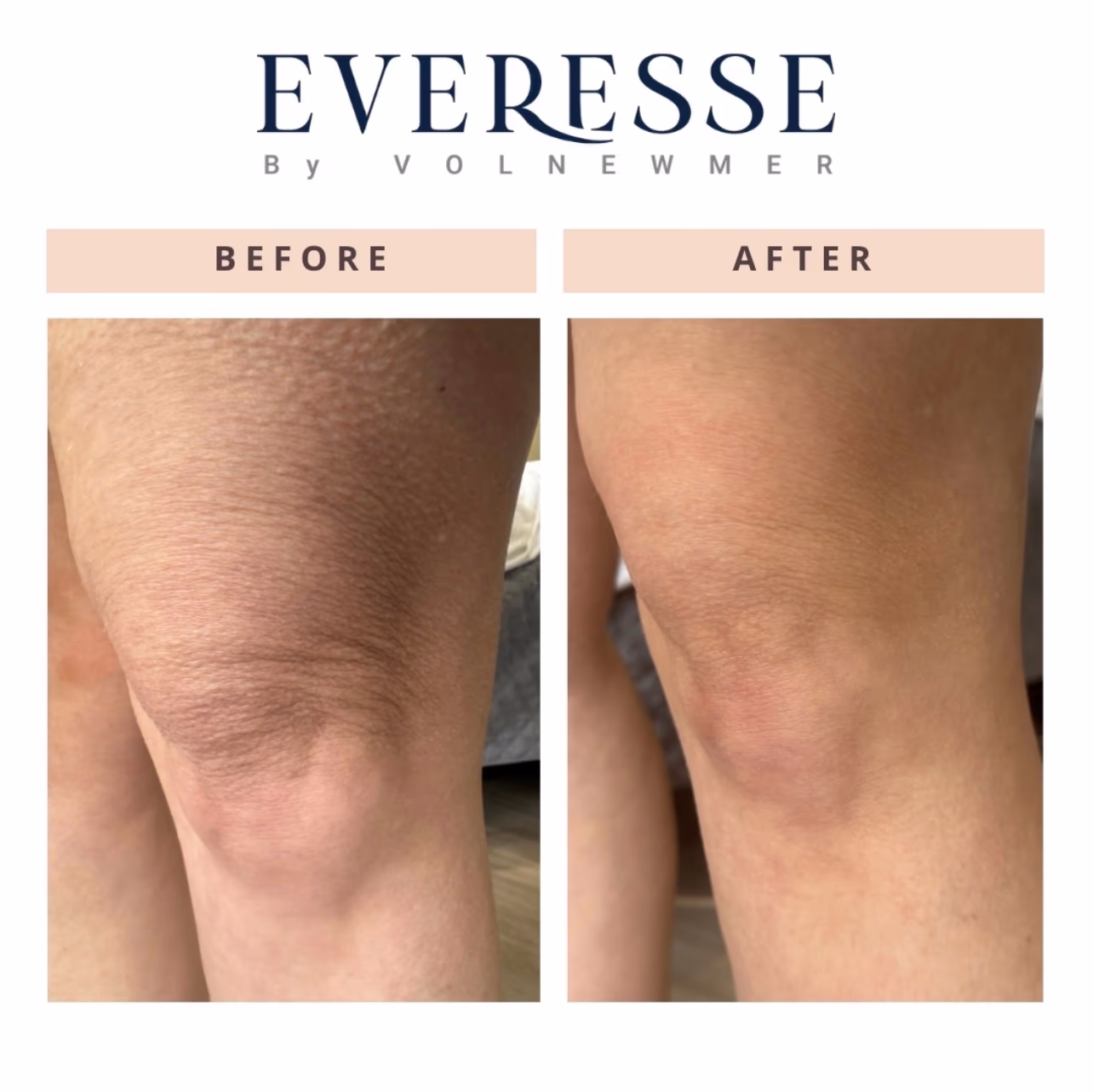 Everesse Knee Before and After Everesse before and after: crepey skin tightening around the knee